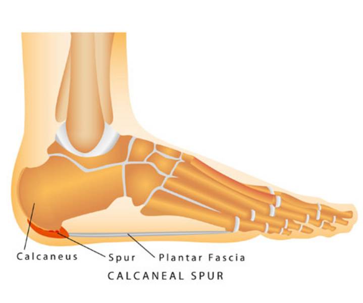 Health Tips | Six Exercises for Plantar Fasciitis and Heel Pain | Choose PT
